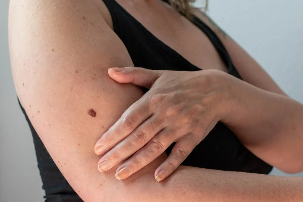 Skin Cancer: Everything You Need To Know